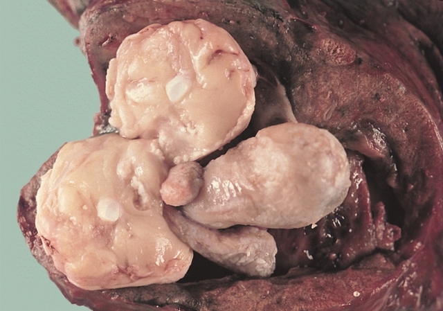 mature image mature wikipedia commons teratoma invading lung