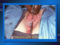 mature vulva pictures phpapp vaginal genitourinary reconstruction tiwarp