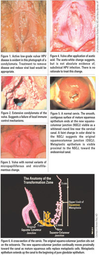 mature vulva pictures sharedresources fig human papillomavirus cervical cancer screening