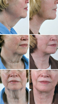 facial mature facelift facial cosmetic surgery